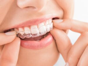 invisalign seattle