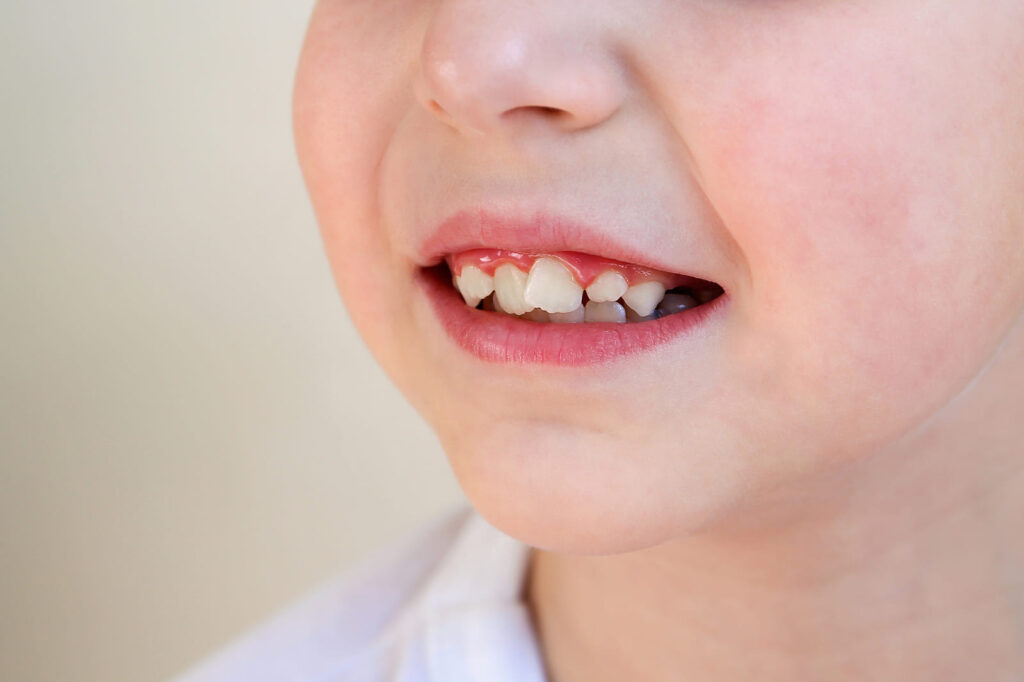 Early signs of orthodontic issues teeth crowding