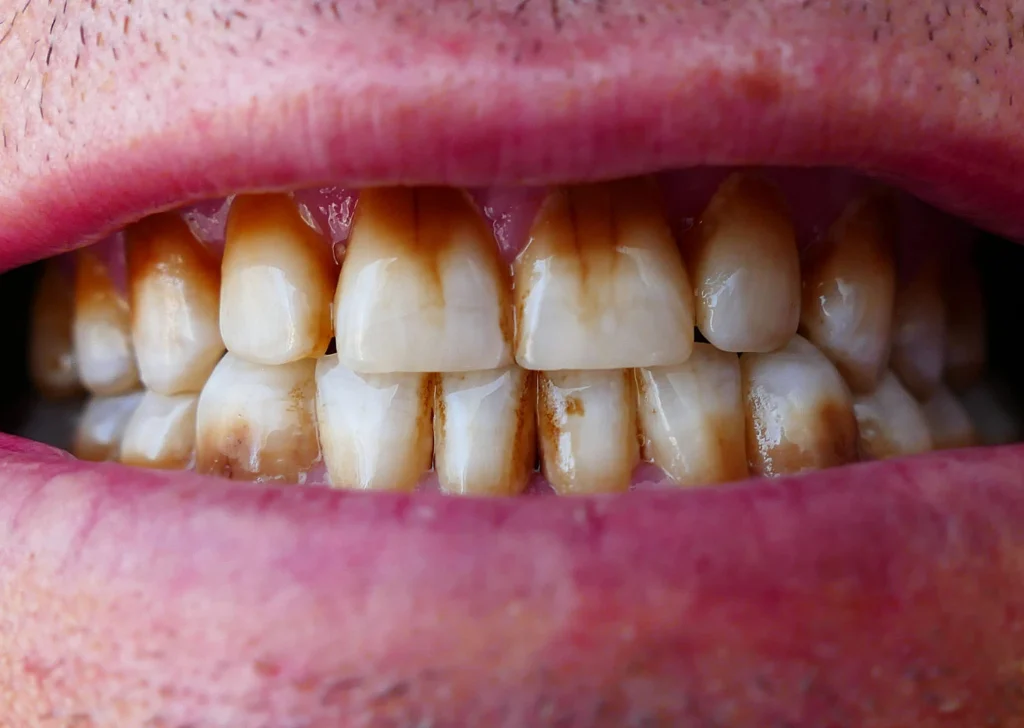 Stained teeth caused by excessive coffee consumption