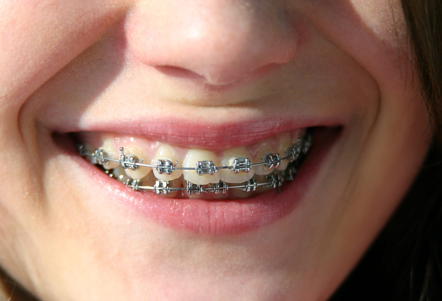 teen smiling during braces treatment near Capitol Hill WA